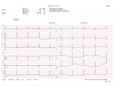 Obr. 4  Dvanctisvodov EKG matky pacienta s negativnmi vlnami T v hrudnch svodech V1V3 pi absenci kompletn blokdy pravho Tawarova ramnka. Nlez spluje velk diagnostick kritrium pro AKMP.