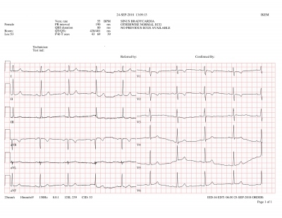 Obr. 4 � Dvan�ctisvodov� EKG matky pacienta s negativn�mi vlnami T v hrudn�ch svodech V1�V3 p�i absenci kompletn� blok�dy prav�ho Tawarova ram�nka. N�lez spl�uje velk� diagnostick� krit�rium pro AKMP.