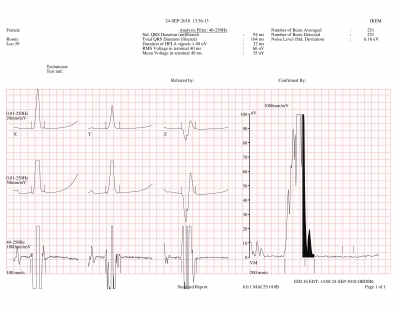 Obr. 5  SAEKG matky pacienta nesplujc mal diagnostick kritrium pro AKMP. Celkov trvn QRS (filtered) je ˂ 114 ms, trvn terminlnho nzkoamplitudovho signlu ˂ 38 ms, stedn kvadratick volt terminlnch 40 ms je ˃ 20 V.