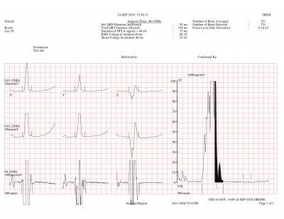 Obr. 5 � SAEKG matky pacienta nespl�uj�c� mal� diagnostick� krit�rium pro AKMP. Celkov� trv�n� QRS (filtered) je ˂ 114 ms, trv�n� termin�ln�ho n�zkoamplitudov�ho sign�lu ˂ 38 ms, st�edn� kvadratick� volt� termin�ln�ch 40 ms je ˃ 20 �V.