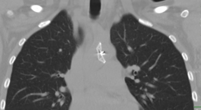 Obr. 2  Nativn CT hrudnku dokumentuje lokalizaci okluderu zasahujc do odstupu truncus brachiocephalicus a sagitln polohu v oblouku aorty
