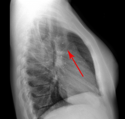 Obr. 1  Sagitln uloen okluderu v oblouku aorty na bonm skiagramu hrudnku
