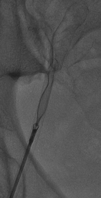 Obr. 4 � Extrakce bioptomem