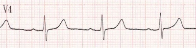 Obr. 7 � EKG p�i propu�t�n�