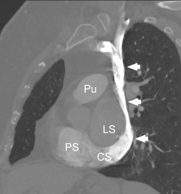 Obr. 2 A  CT angiografie s planrn rekonstrukc v ikm parakoronln rovin (A) a s volumovou rekonstrukc v elnm (B) a levm bonm (C) pohledu. Na obrzcch je patrn perzistujc levostrann vena cava superior (ipky) jdouc vlevo laterln podl lev sn (LS) a komory (LK) a stc do dilatovanho koronrnho sinu (CS) a do prav sn (PS). Pro anatomickou pehlednost je oznaena tak aorta (Ao), plicnice (Pu), prav komora (PK) a lev s (LS).