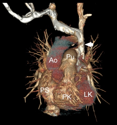 Obr. 2 B  CT angiografie s planrn rekonstrukc v ikm parakoronln rovin (A) a s volumovou rekonstrukc v elnm (B) a levm bonm (C) pohledu. Na obrzcch je patrn perzistujc levostrann vena cava superior (ipky) jdouc vlevo laterln podl lev sn (LS) a komory (LK) a stc do dilatovanho koronrnho sinu (CS) a do prav sn (PS). Pro anatomickou pehlednost je oznaena tak aorta (Ao), plicnice (Pu), prav komora (PK) a lev s (LS).