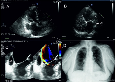 Obr. 1 � (A) Transthorak�ln� echokardiogram (TTE), modifikovan� projekce PLAX: P��tomna dilatace koron�rn�ho sinu (CS) � b�l� �ipka. (B) TTE � dilatovan� CS (b�l� �ipka). (C) Transezofage�ln� echokardiogram (TEE): viditeln� dilatovan� CS (b�l� popisek), v prav� ��sti obr�zku zobrazena st�edn� v�znamn� mitr�ln� regurgitace. (D): Rtg obraz hrudn�ku v zadop�edn� projekci: Na rozhran� st�edn�ho a doln�ho plicn�ho pole vlevo p��tomen st�n odpov�daj�c� ulo�en� izolovan� perzistuj�c� levostrann� horn� dut� ��ly. 