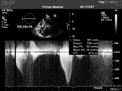 Obr. 3 � Vysok� gradient p�i Valsalvov� man�vru sv�d��c� pro v�znamnou obstrukci v LVOT