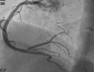 Obr. 10 � Fin�ln� v�sledek po implantaci stent� (Cre8 EVO 3,5 � 46 mm a 3,5 � 20 mm) a postdilatace non-compliantn�m balonkov�m kat�trem Pantera LEO 4,0 � 20 mm v cel�m rozsahu 