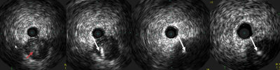 Obr. 5 � IVUS zaveden do ramus ventricularis a za real-time kontroly IVUS byla provedena �sp�n� punkce proxim�ln� ��sti uz�v�ru CTO (�erven� �ipka) vodi�em Confianza Pro (ASAHI INTECC) (b�l� �ipka).