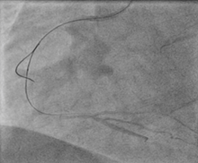 Obr. 6 � Rekanaliza�n� vodi� Fielder XT v n�st�nn� disekci tepny subintim�ln�, kde byl ponech�n na m�st� jako �marker wire�.