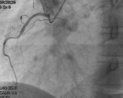 Obr. 1 � Vstupn� angiografie prav� v�n�it� tepny (ACD)