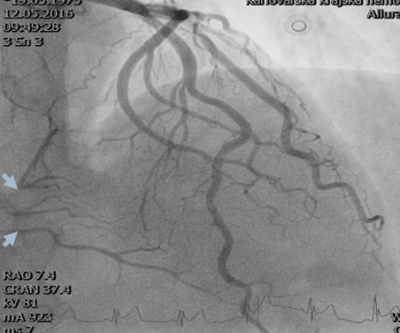 Obr. 2 � Diagnostick� n�st�ik lev� v�n�it� tepny � patrn� jsou okrajov� nerovnosti na ramus interventricularis anterior a pln�n� periferie prav� v�n�it� tepny n�kolika sept�ln�mi kolater�lami (modr� �ipky).
