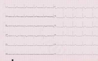 Obr. 2  Typ 1 brugadovskho EKG: alespo 2mm elevace bodu J ve svodu V1 s navazujcm descendentnm sekem ST pechzejcm do negativn vlny T