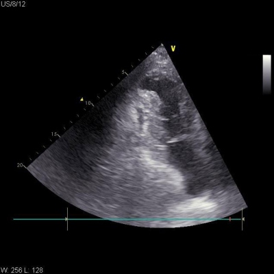Obr. 2 � (A) Echokardiografick� obraz v A2CV projekci po perikardiocent�ze s n�slednou intraperikardi�ln� aplikac� trombinu 