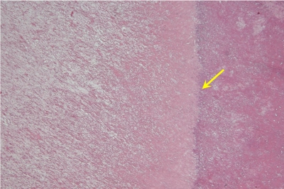 Obr. 8  Histologick ez KAT. lut ipka oznauje pechod kalcifikovan povrchov vrstvy do bezstrukturn sti benignho tumoru, barven hematoxylin-eosinem, zvten 40.