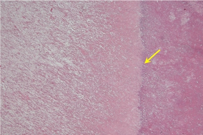 Obr. 8 � Histologick� �ez KAT. �lut� �ipka ozna�uje p�echod kalcifikovan� povrchov� vrstvy do bezstrukturn� ��sti benign�ho tumoru, barven� hematoxylin-eosinem, zv�t�en� 40�.