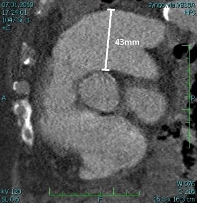 Obr.1  (B) CT angiografie s prkazem dilatace plicnice, sagitln ez