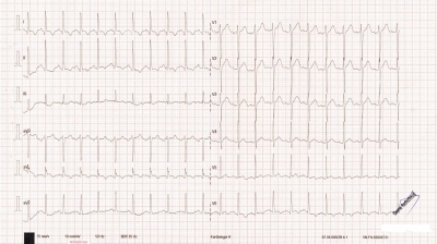 Obr. 2 � Kontroln� EKG se zv�razn�n�m zm�n segmentu ST ve svodech I, aVL, V5�V6