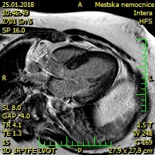 Obr. 4 � Magnetick� rezonance srdce � fokusy neischemick� fibr�zy v baz�ln�m segmentu anterosepta a zadn� st�ny