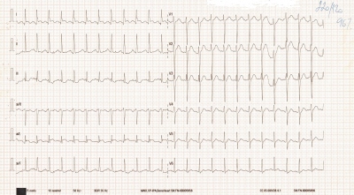 Obr. 1 � EKG zn�mky hypertrofie LK, kr�tk� interval PR a 1,5mm elevace segmentu ST ve svodech I, aVL 