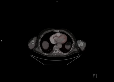 file_5db09b728292e_108_Kazuistika_Madron_Video_6_-_PET-CT_po_sesti_mesicich_od_zahajeni_lecby_-_kompletni_remise.mp4.mp4