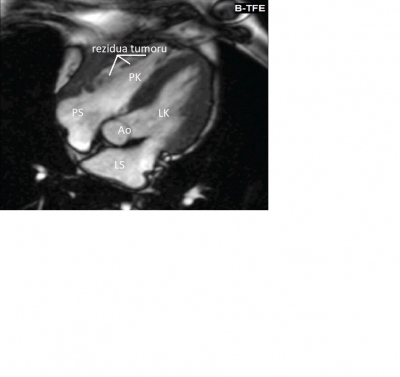 Obr. 3 � Magnetick� rezonance srdce, �ty�dutinov� projekce � z�eteln� regrese tumoru po dokon�en�m 3. cyklu chemoterapie. Ao � aorta; LK � lev� komora; LS � lev� s��; PK � prav� komora; PS � prav� s��. 