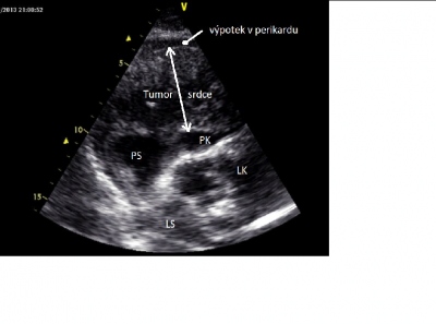 Obr. 1. � Echokardiogram srdce, subxifoide�ln� projekce � patrn� tumor�zn� infiltrace st�ny prav� s�n� a prav� komory. LK � lev� komora; LS � lev� s��; PK � prav� komora; PS � prav� s��. 