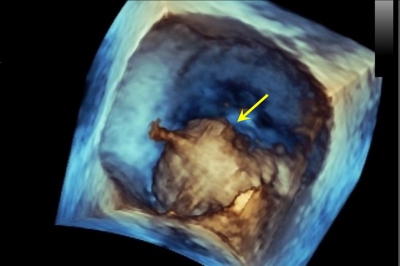 Obr. 3 � 3D echokardiografie. Ovoidn� �tvar v lev� s�ni (�lut� �ipka).
