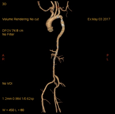 Obr. 2  CT angiografie 3D rekonstrukce  koarktace za odstupem arteria subclavia, zen zcela distln hrudn a bin aorty