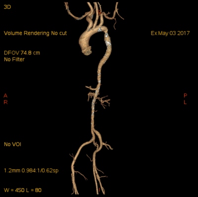 Obr. 2 � CT angiografie 3D rekonstrukce � koarktace za odstupem arteria subclavia, z��en� zcela dist�ln� hrudn� a b�i�n� aorty