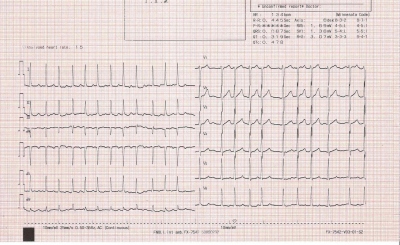 Obr. 1  Vstupn EKG  fibrilace sn s rychlou komorovou odpovd