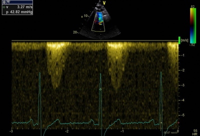 Obr. 6  Echokardiografick vyeten  dopplerovsk gradient v descendentn aort 43 mm Hg