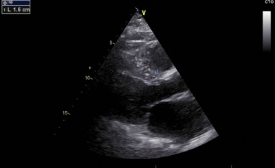 Obr. 7 � Vstupn� echokardiografie s hypertrofi� st�n lev� komory