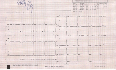 Obr. 5 � EKG po obnoven� sinusov�ho rytmu