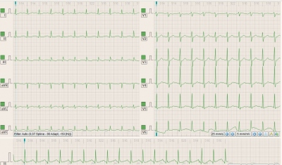 Obr. 1  EKG