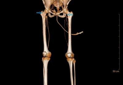 Obr. 3 � CT angiografie tepenn�ho �e�i�t� doln�ch kon�etin, vstupn� vy�et�en�. Vpravo uz�v�r arteria femoralis communis zasahuj�c� do bifurkace, vlevo uz�v�r arteria iliaca interna i externa, del�� uz�v�r arteria femoralis communis, p�esahuj�c� na arteria femoralis superficialis i na arteria femoralis profunda (ozna�eno modr�mi �ipkami).