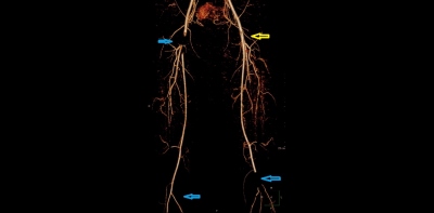 Obr. 4 � CT angiografie, kontroln� po pod�n� trombol�zy. Vlevo rekanalizace p�nevn�ch tepen i arteria femoralis communis, arteria femoralis profunda i arteria superficialis (ozna�eno �lutou �ipkou), p�etrv�v� okluze truncus tibiofibularis. Vpravo p�etrv�v� uz�v�r a. femoralis communis a okluze truncus tibiofibularis. (modr� �ipky).
