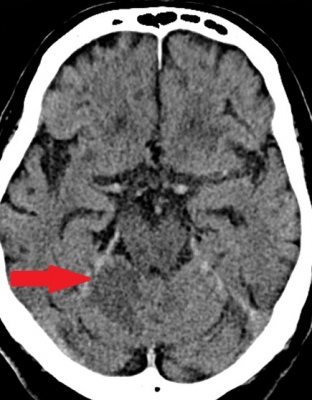 Obr. 4  Kontroln CT mozku druh den hospitalizace, transverzln ez: ischemick zmny prav mozekov hemisfry
