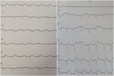 Obr. 1  EKG pi pijet: elevace seku ST ve svodech I, aVL, V2V6