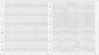 Obr. 1  Vstupn EKG s monomorfn komorovou tachykardi s morfologi LBBB