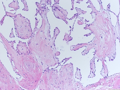 Obr. 4 � Papil�rn� fibroelastom, histologick� n�lez p�i barven� hematoxylin-eosinem
