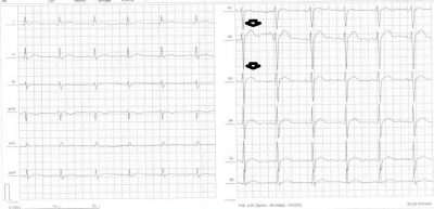 Obr. 1 � EKG pacienta p�ed operac�. �ipky ozna�uj� zm�ny repolariza�n� f�ze.