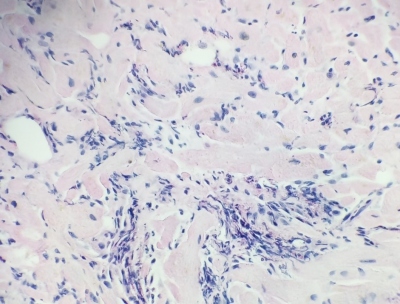 Fig. 2 � Eosinophilic infiltrate of the myocardial interstitium.