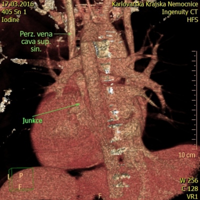 Obr. 2  CT venografie s 3D rekonstrukc. Perzistujc venacava superior sinistra st pes ostium do koronrnho sinu.