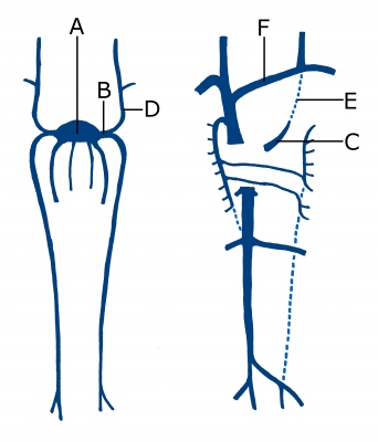 Obr. 5  Schma primordilnch vn trupu plodu ve st esti tdn (vlevo). Stav u dosplho (vpravo). Sinus venosus (A), do kterho st venacardinaliscommunissinistra (B). Jej reziduum v dosplosti  sinus coronarius (C). Venacardinalisanteriorsinistra (D), jejm pozstatkem je Marshallovo ligamentum (E). V osmm tdnu vznik anastomza pednch kardinlnch il, ze kter se vyvj venabrachiocephalicasinistra (F). 