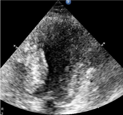 Obr. 2  Echokardiografie: systolick apicalballooning (ppad 2)