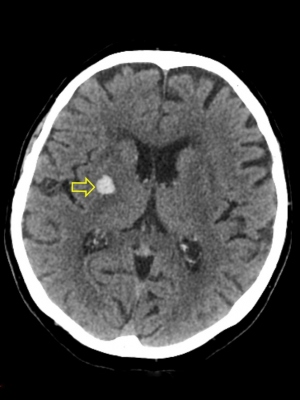 Obr. 1 � Prvn� sn�mek ze dne 15. 2. 2018 ukazuje mal� intracerebr�ln� hematom v corona radiata v bl�zkosti capsula interna velikosti 12 � 10 � 20 mm.