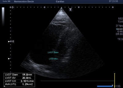 Obr. 3  Vstupn echokardiografick obraz peten pravostrannch srdench oddl, apikln tydutinov projekce