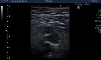 Obr. 4  Sonografick obraz z proximlnho seku stehna s nekomprimovatelnou dilatovanou femorln lou
